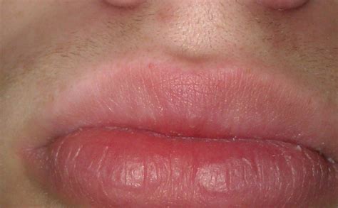 Peeling Lips Yeast Infection Guide
