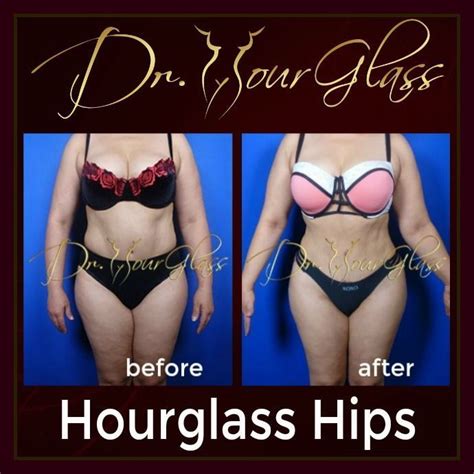 The Hourglasships Procedure Is One Of The Best Procedure You Can
