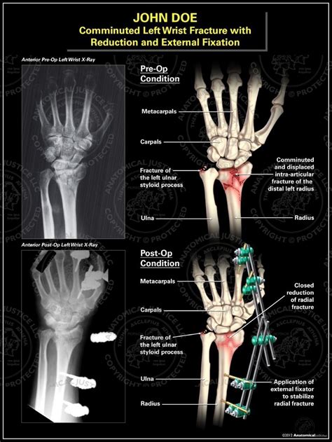 Comminuted Left Wrist Fracture With Reduction And External