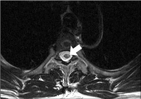 Mri T2 Weighted Axial Images Reveal A Short Segmental Diffuse Area Of
