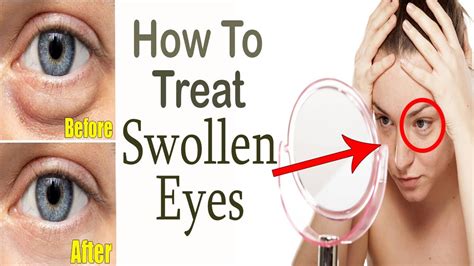 How To Get Rid Of Swollen Eyes At Home Home Remedies For Swollen