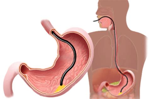 Endoscopia digestiva o que é para que serve e preparo Vida saudavel