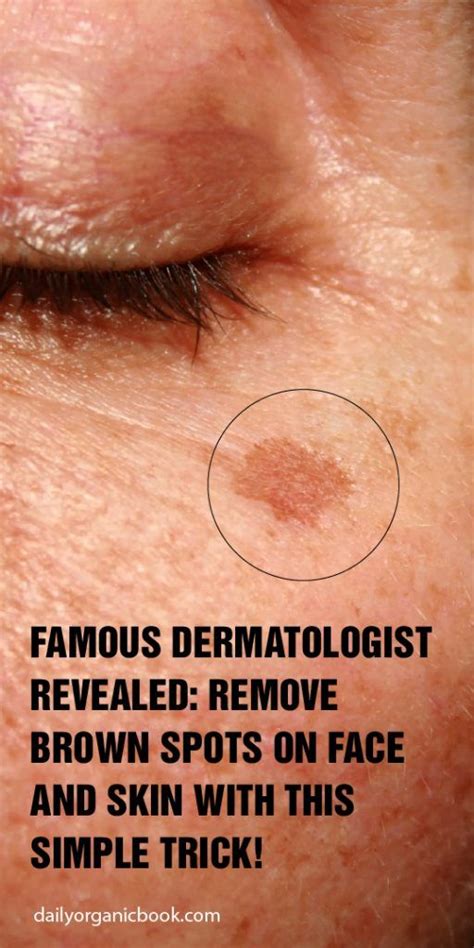 Famous Dermatologist Revealed Remove Brown Spots On Face And Skin With
