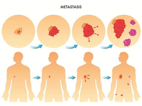 Cancer De Seno Con Metastasis