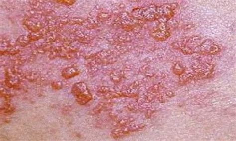 Shingles Signs And Symptoms Best Online Md