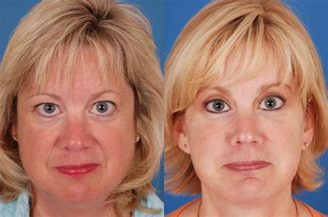 Facelift Before And After Photos Benjamin Bassichis Md Facs