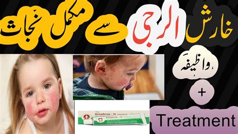 Skin Allergy Ko 100 Khatam Karne Ki Treatment At Home How To Cure