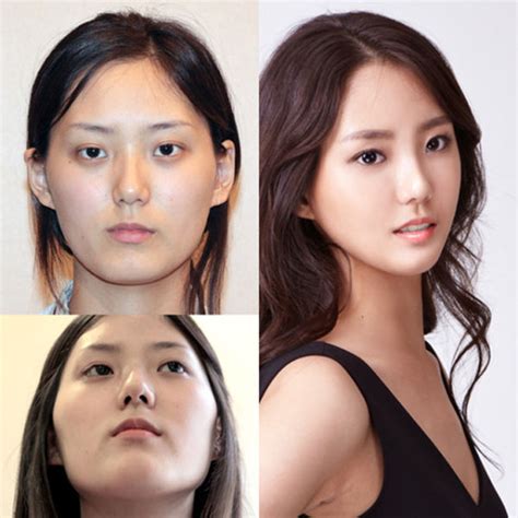 Before And After Photos Of Korean Plastic Surgery Part Pics Picture Izismile
