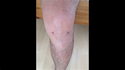 Knee Arthroscopykeyhole Surgery For Meniscus Tear Youtube