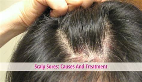 Hallmarks of hard bumps on the scalp. Scalp Sores: Causes And Treatment