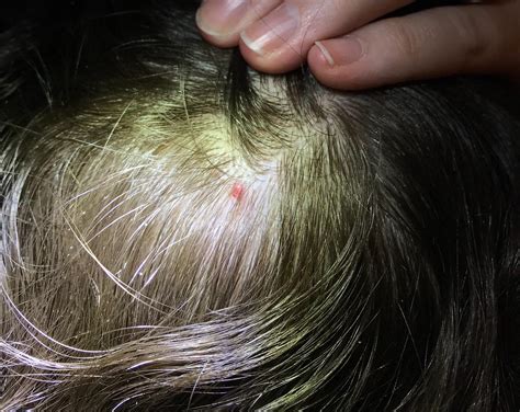 What Is This Small Red Bump On My Head It Is Tender Bleeds And Has