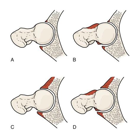 変形性股関節症の初期に効果的!20の改善運動を理学療法士が紹介