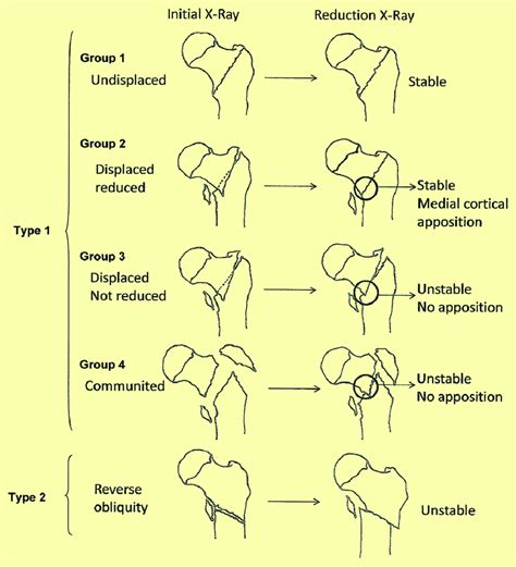 Evan S Classification Of Intertrochanteric Fractures Fractures The