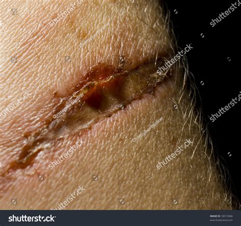 Healing Flesh Wound Stock Photo 18313366 Shutterstock