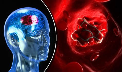 Stroke Breakthrough Scientists Discover Way To Detect Deadly Blood