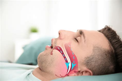 Treatment Options For Sleep Apnea In Australia Piccolofiorenyc