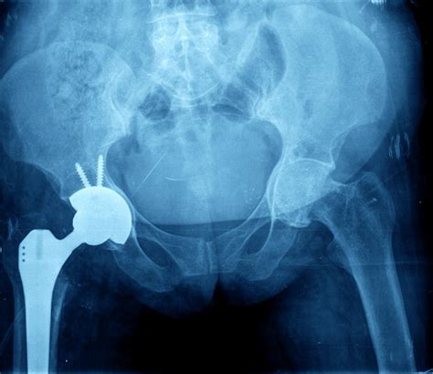 Hip Replacement Types Of Surgeries