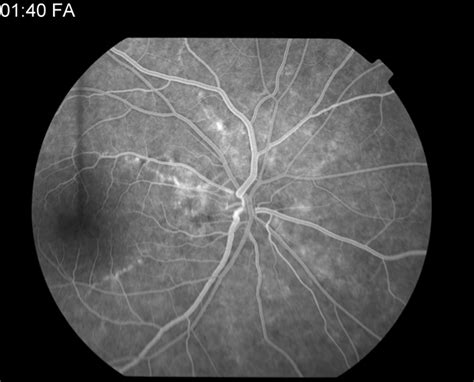 Angioid Streaks Retina Image Bank