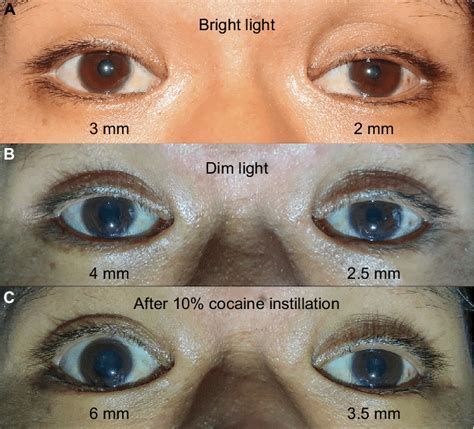Pupillary Examination Shows Anisocoria Notes A In Bright Light The