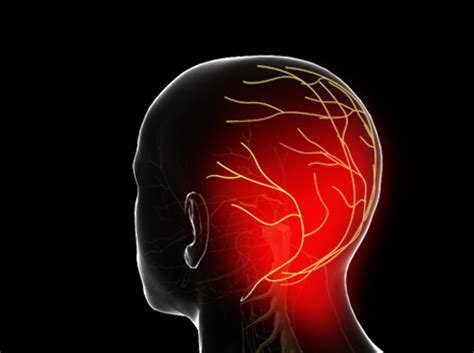 Video Occipital Neuralgia Arnolds Neuralgia Healthclips Online