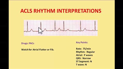 Printable Ekg Practice Strips