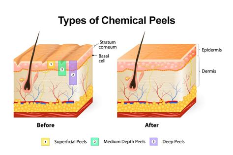 Chemical Peel Candidates Fullerton Ca Cosmetic Dermatology And Skin
