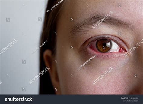 Close Irritated Infected Red Bloodshot Woman Stock Photo 2107408406