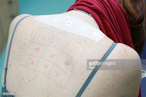 Allergy Test Photos And Premium High Res Pictures Getty Images