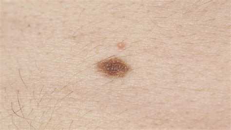 Skin Cancer Early Detection