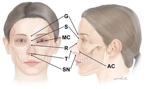 Botulinum Neurotoxin Injection For Wrinkles In Nose Region