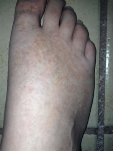 Weird Brown Freckle Like Spots On Feet Askdocs