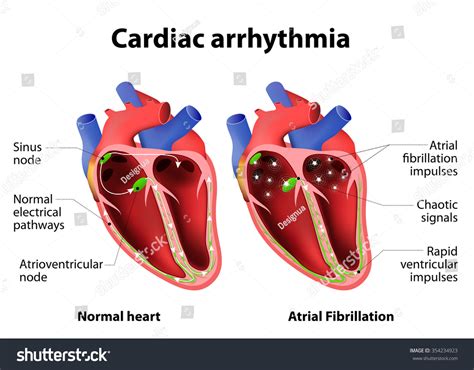 Cardiac Arrhythmia Cardiac Dysrhythmia Or Irregular Heartbeat Medical