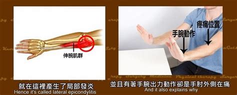 The site owner hides the web page description. 不打網球竟有網球肘？復健師解疑惑 | 復健治療 | 骨科 | 健康新知 | 華人健康網