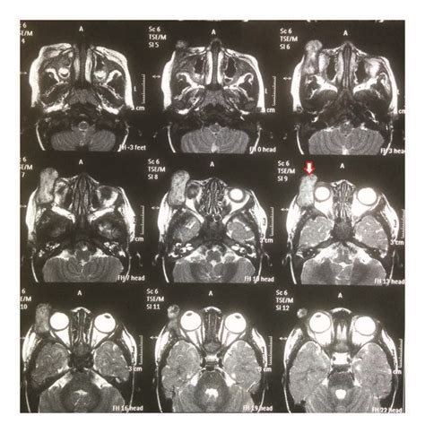 Prechemotherapy Mri Scan Showing Localization And Extent Of