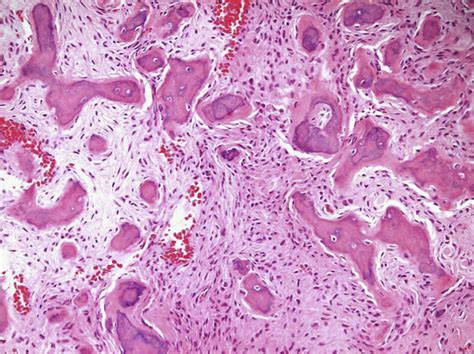 Fibro Osseous Lesions Of The Head And Neck Diagnostic Histopathology