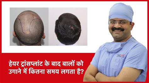 This ensures that the scalp accepts the transplants. How Long It Takes For Hair To Grow After Hair Transplant ...
