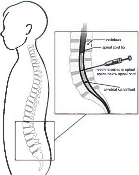 Pediatric Lumbar Puncture Conditions And Treatments Childrens