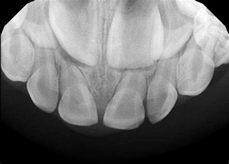 dental  rays   tooth pediatric dental blog