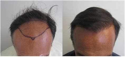 Hair Transplant Los Angeles Cost Cost Of Hair Restoration In Los Angeles