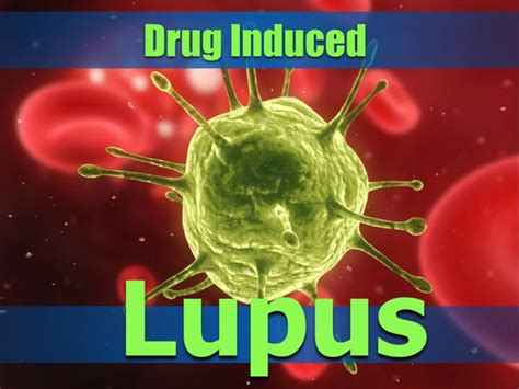 Drug Induced Lupus Medications Aggravating Your Lupus