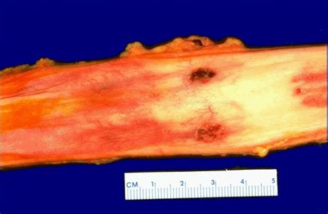 Epidemiology — herpes simplex virus (hsv) infection of the esophagus is usually observed in patients who are immunocompromised, but can occasionally be seen in patients who are. Pathology Outlines - Herpes simplex esophagitis