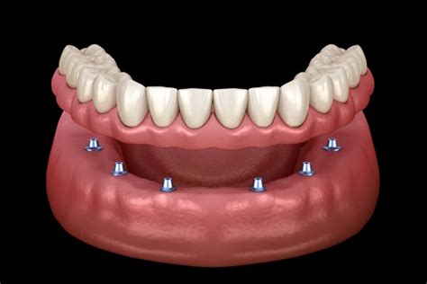 Comparing Implant Supported Dentures To Conventional Frankford Dental