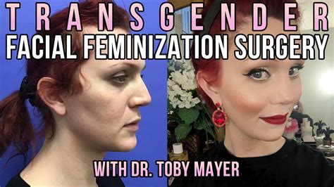 Transgender Facial Feminization Surgery Before And After Dr Toby