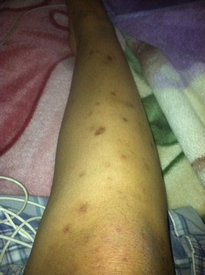 Excessive scratching can even damage the skin. I have bug bite scar all over my arms and legs I want to ...