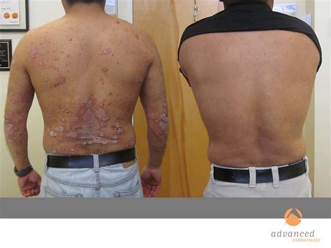 Psoriasis Treatment In Chicago Il Advanced Dermatology