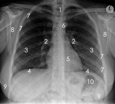 Anatomy Of Chest X Ray Normal Chest Xray Stock Photo Download Image