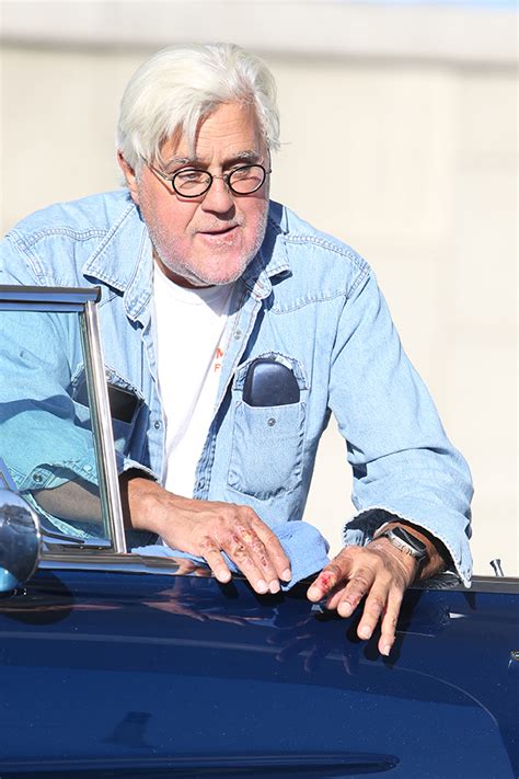 Jay Leno Reveals Face Hand Scars As He Returns To Driving Vintage Cadillac 1 Day After Hospital