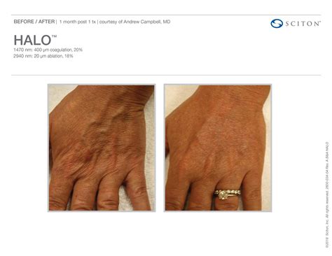 Halo™ Laser Treatments In Monroe For Skin Resurfacing