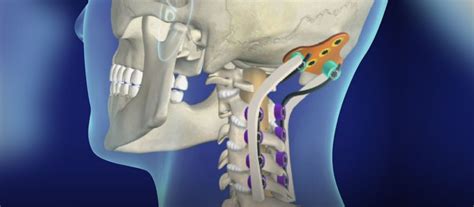 Occipito Cervical Fixation Oc Fusion Haider Spine Center