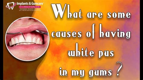 What Are Some Causes Of Having White Pus In My Gums By Toothhq